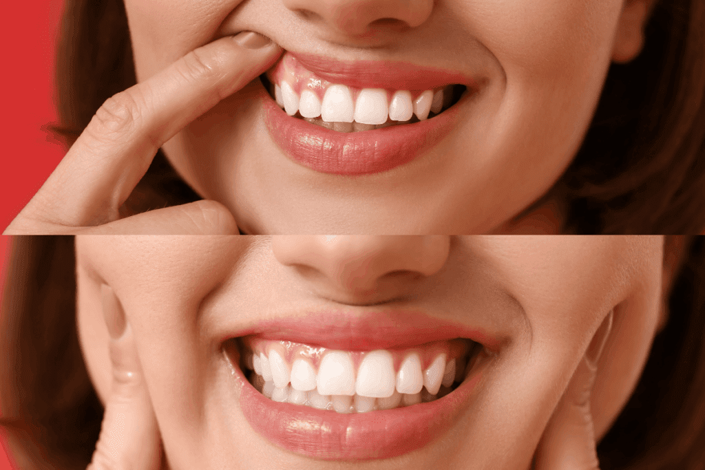 Gum Treatment PJ, Malaysia White Density