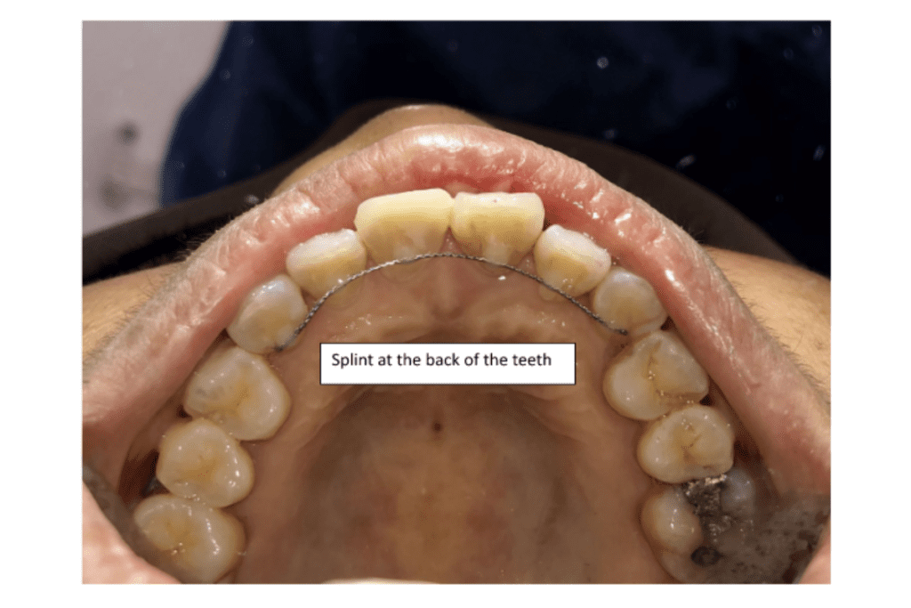 Dental trauma white density